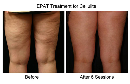 EPAT Treatment for Cellulite