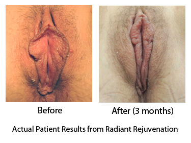 Labiaplasty and Hood Reduction