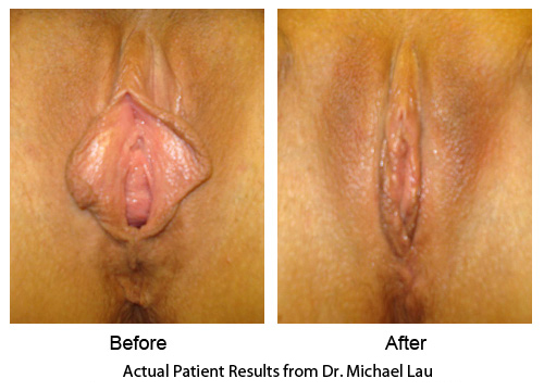 Vaginal Rejuvenation - Labiaplasty