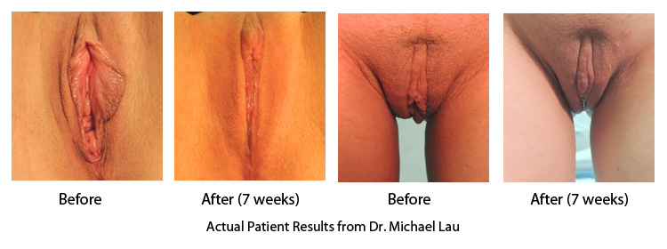 Vaginal Rejuvenation and Labiaplasty