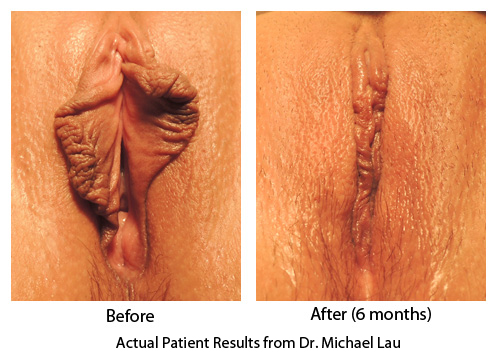 Vaginal Rejuvenation - Labiaplasty